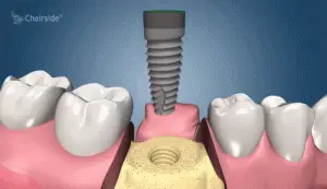 Dentist near me, dentista cerca de mi, best dentist miami, mejor dentista miami, pizza near me, chinese near me, food near me, crown dentist miami, cheapest dentist miami, root canal dentist miami, cheapest root canal miami